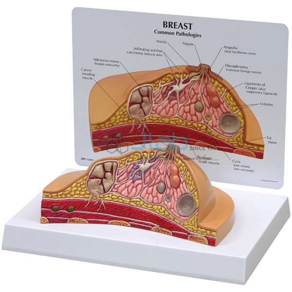 Cancer Model