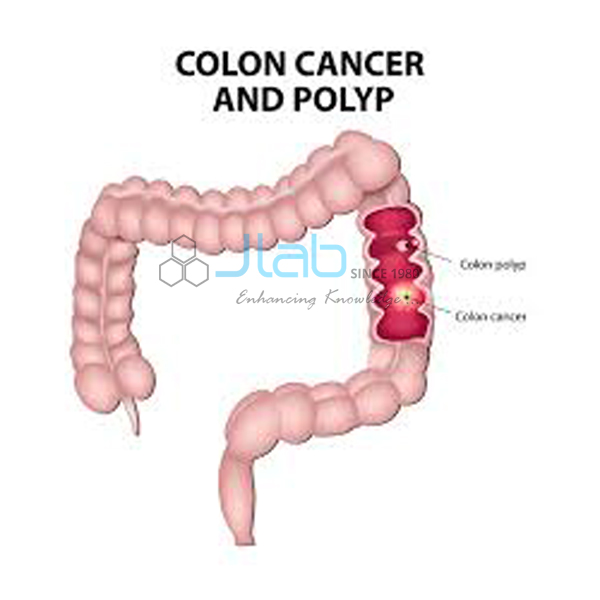 Colon Cancer and Polyp Model