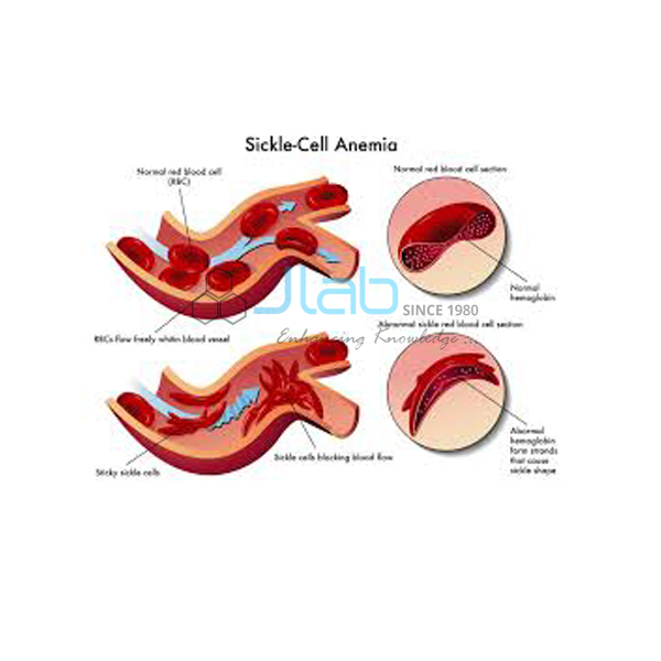 Sickle Cell Anemia Model