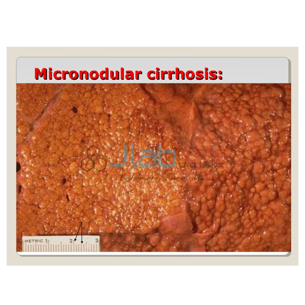 Micronodular Cirrhosis Model