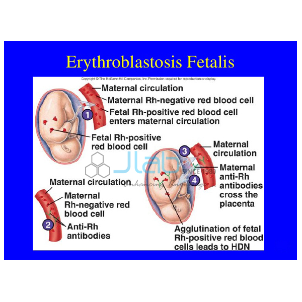 Erythroblastosis Fetalis Model