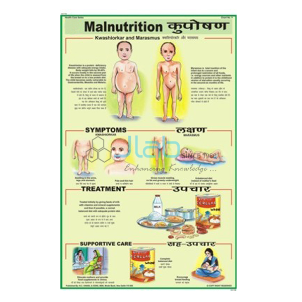 Malnutrition Chart