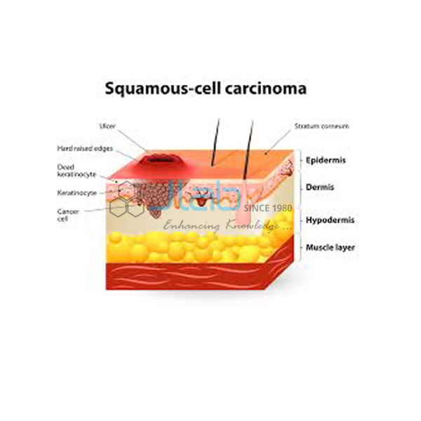 Squamous Cell Carcinoma Model