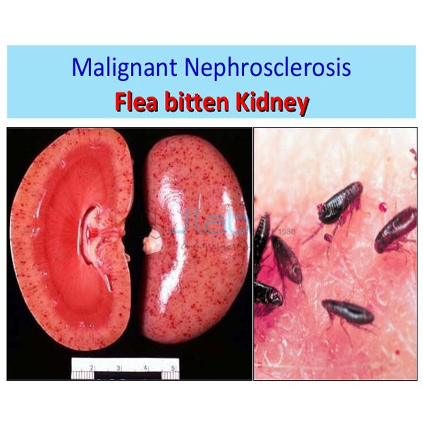 Malignant Nephrosclerosis, Flea Bitten Kidney Model