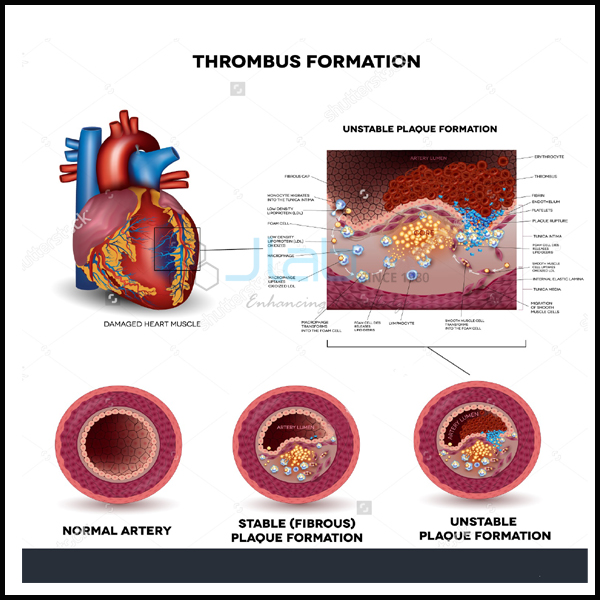 Clot Formation in Artery Chart