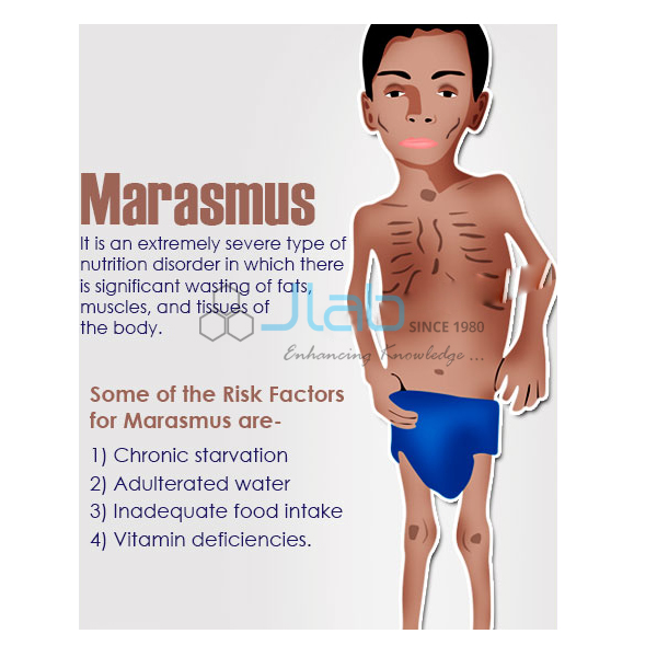 Marasmus Model