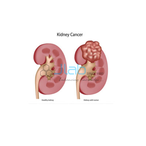 Wilms Tumor Model