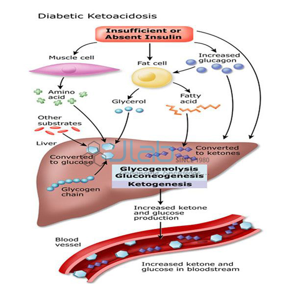 Diabetic Ketoacidosis Model