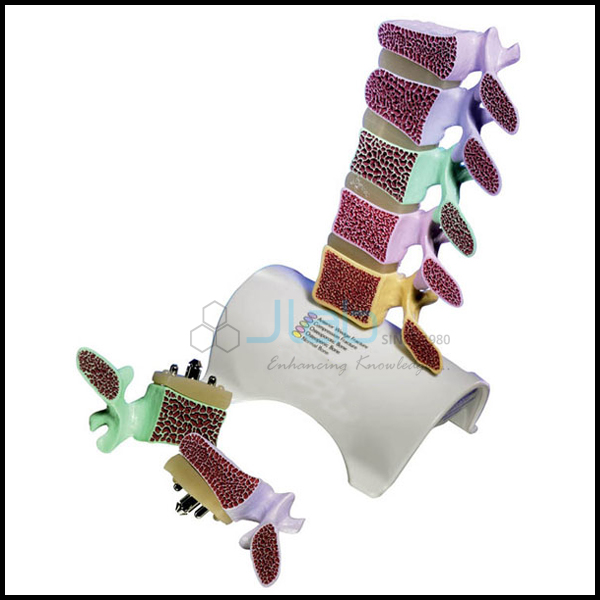 Ankylosing Spondylitis Spine Model