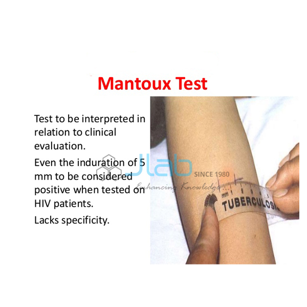 Mantoux Test Model