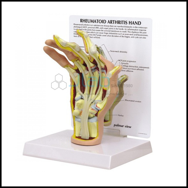 Hand Arthritis Model
