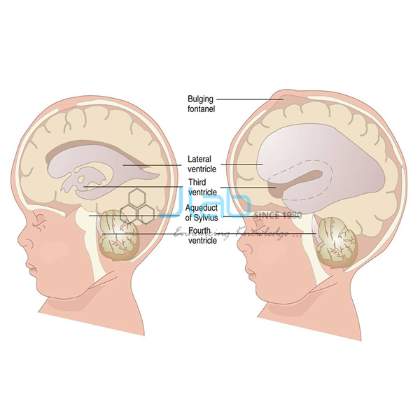 Hydrocephalus Model