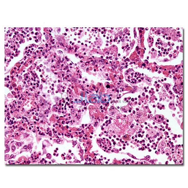 Lobar Pneumonia Grey Hepatisation Model