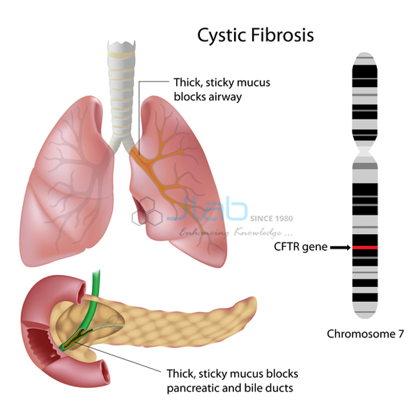 Cystic Fibrosis Model