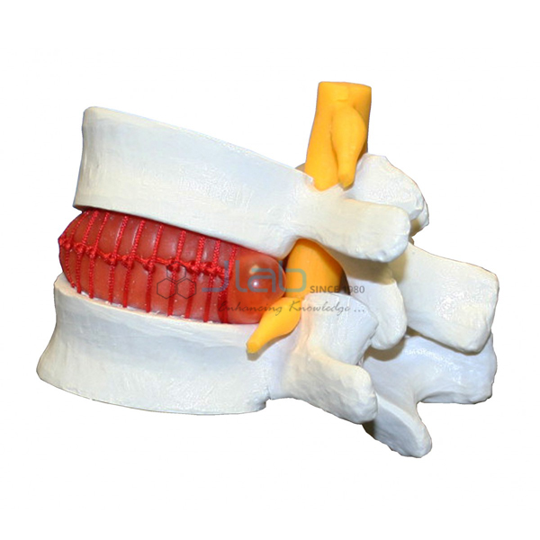 Prolapsed Intervertebral Disc