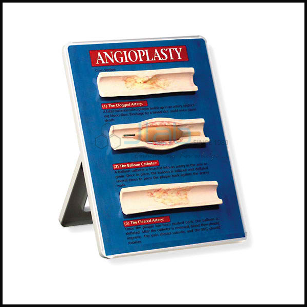 Balloon Angioplasty Models