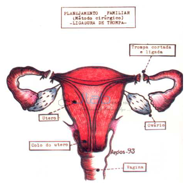 Tubectomy Model