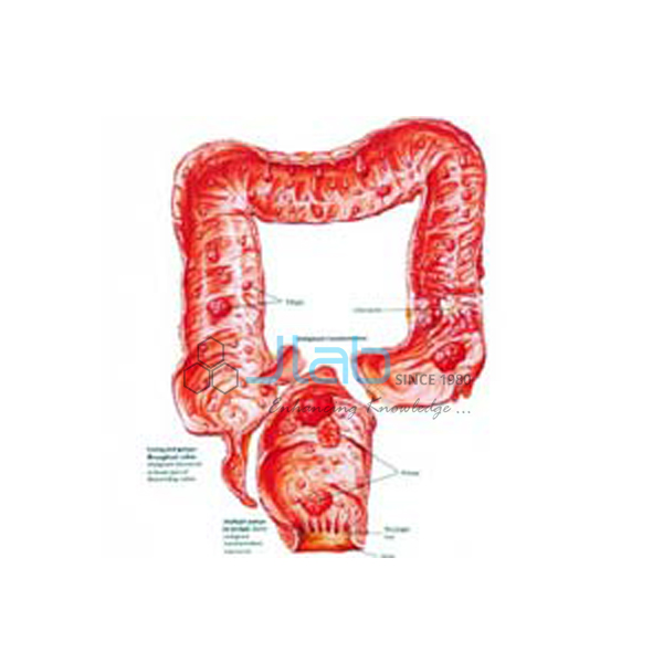 Familial Polyposis of Large Intestine Model