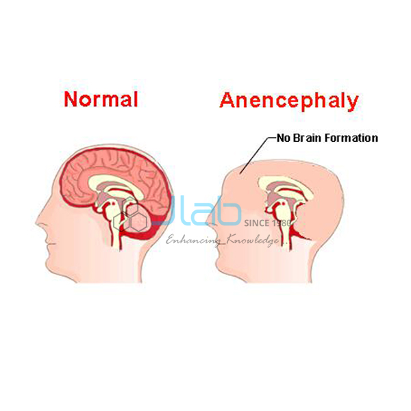 Anencephaly Model