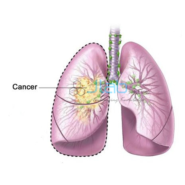 Lung Cancer Model
