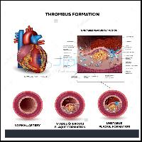 Clot Formation in Artery Chart