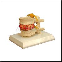 Disc Prolapse Simulator Model