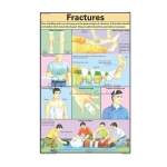 Fractures Chart