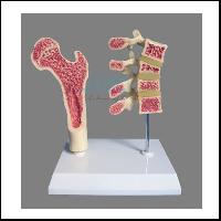 Menopausal Osteoporosis Model